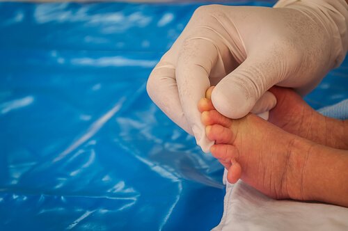 Le syndrome de Patau chez les bébés