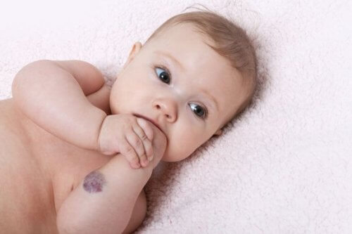 Malformations crâniofaciales chez les nourrissons