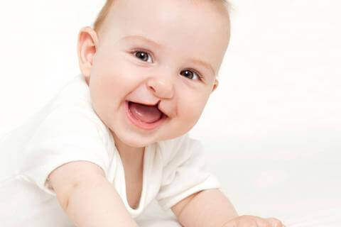 Bébé né avec une malformation