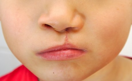 Malformations au niveau des lèvres