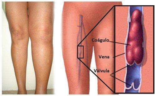 Le schéma de la thrombose