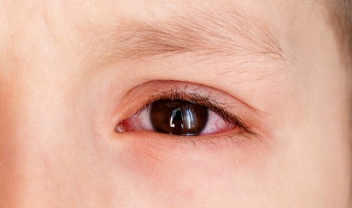 Épanchements oculaires chez les enfants