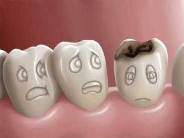Que sont les caries dentaires et comment peut-on les prévenir ?