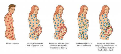Cas d'incompatibilité de Rhésus