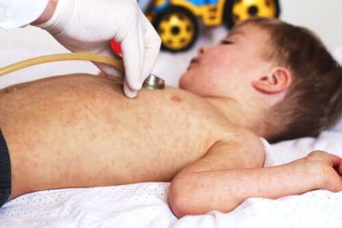 enfant avec la rougeole chez le docteur