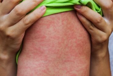 Les épidémies de rougeole et l'importance de la prévention