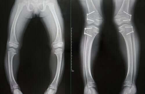 radiographie de rachitisme