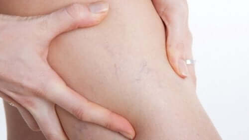 varices sur les jambes d'une femmes
