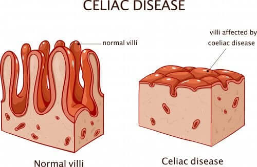 La maladie coeliaque dans l'intestin