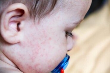 Irritations Cutanees Chez Les Bebes Que Faire Etre Parents