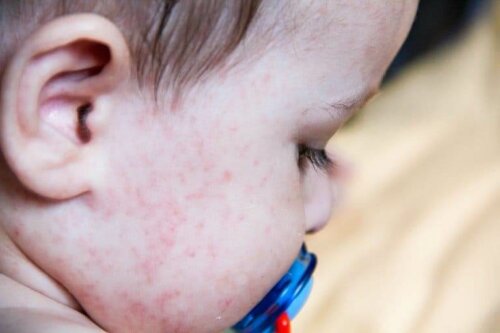 Irritations cutanées chez les bébés : que faire ?