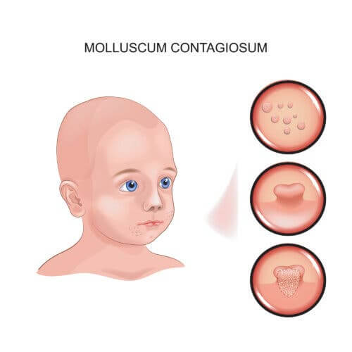 Le dessin d'un enfant et molluscum