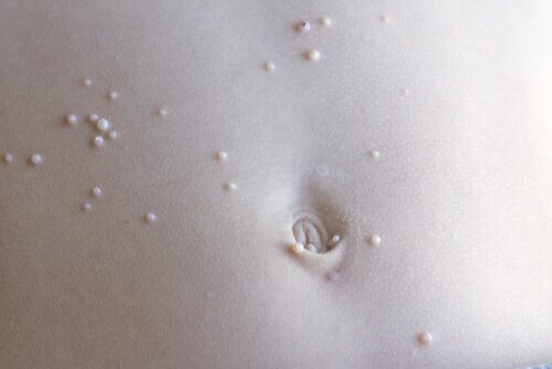 Que faire si mon enfant a des molluscum ?
