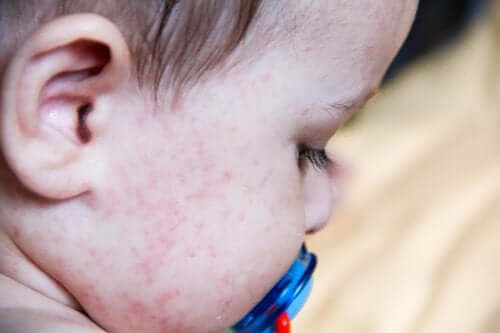 Informer au maximum que l’enfant est allergique au latex.