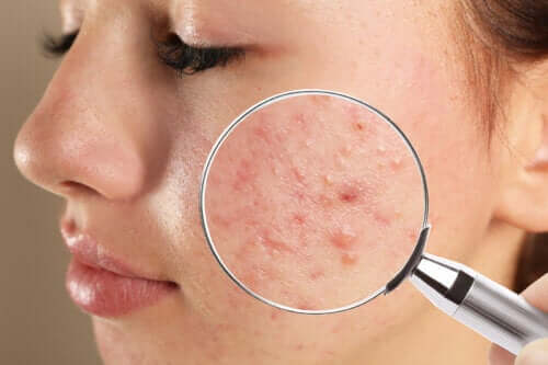 Types et causes de l’acné juvénile