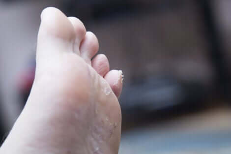 La dermatite plantaire.