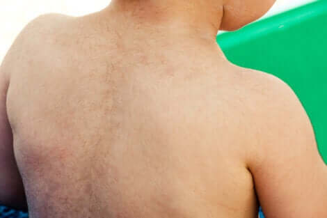 Hypertrichose dans le dos d'un enfant.