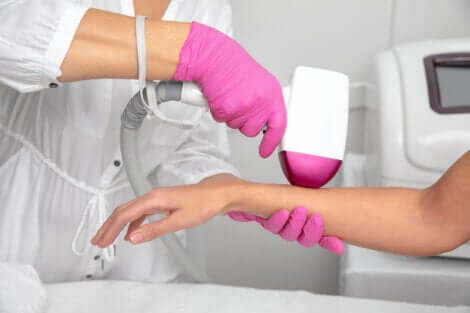 Epilation du bras au laser.