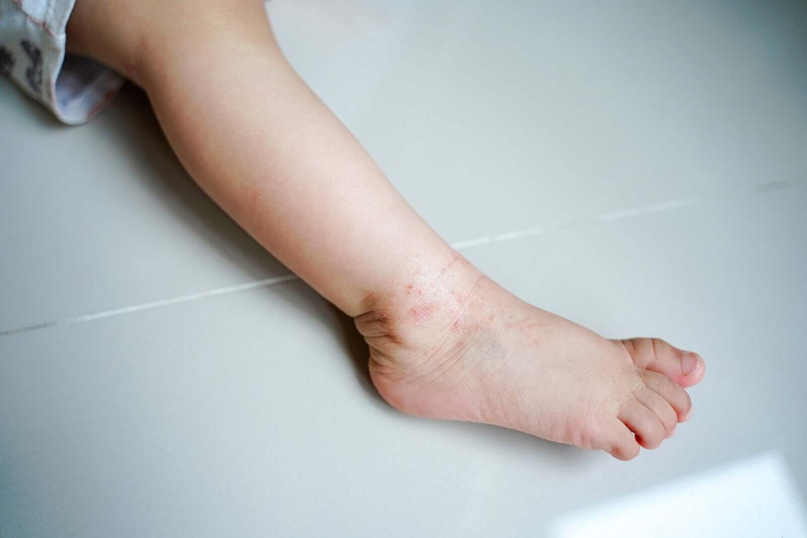 Un pied de bébé avec de l'eczéma.