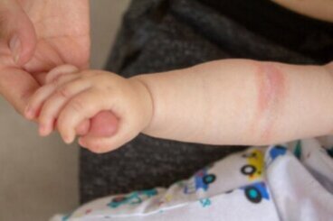 Alimentation et eczéma chez les bébés