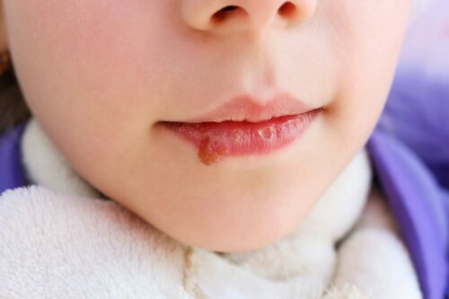 La candidose orale sur la lèvre d'un enfant.