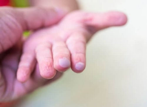 La main d'un enfant avec des ampoules.