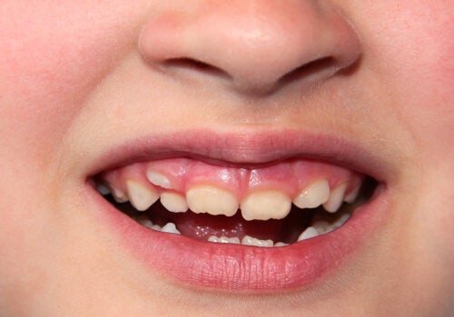 Dents déplacées chez les enfants: que faire?