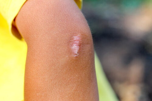 Comment soigner les cicatrices chez les enfants?