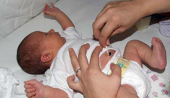 traitement du cordon ombilical