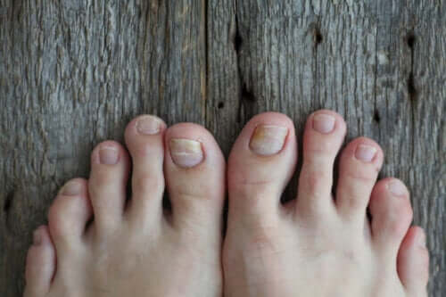 Comment traiter la mycose des ongles chez les enfants ?