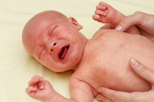 Pétéchies chez le bébé: causes, symptômes et traitement