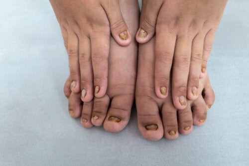 Changements de couleur des ongles des enfants: Quelles sont les causes?