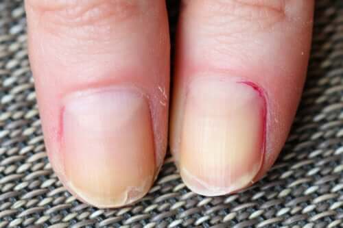 Remèdes maison pour renforcer les ongles après l'accouchement