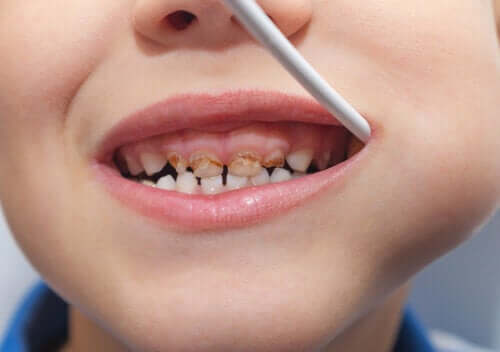 Pourquoi mon enfant a-t-il une dent de lait noircie ?