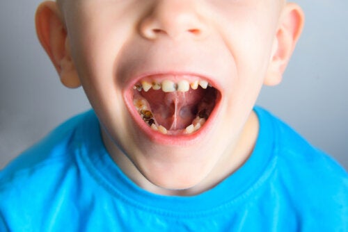 Causes des dents de lait tachées chez les enfants