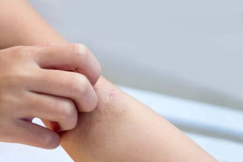 Taches blanches sur la peau des enfants