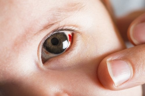 A quoi correspondent les taches rouges dans les yeux des bébés?
