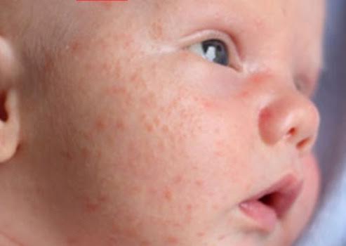 Qu’est-ce que l’acné du nourrisson?