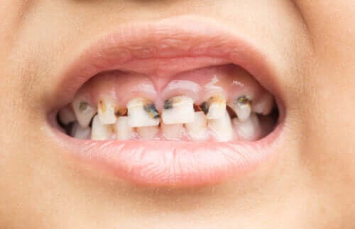 Faut-il traiter les caries des dents de lait ?