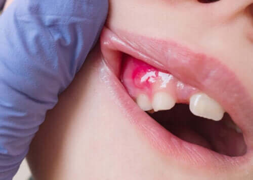 Maladies des gencives chez les enfants