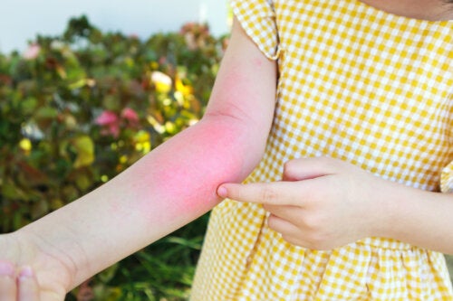 10 conseils pour traiter la dermatite de contact