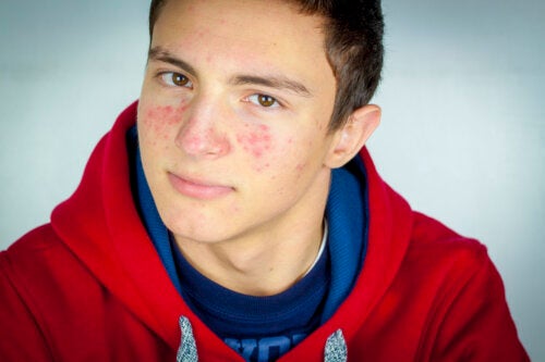Adolescents et acné : choses à faire et à ne pas faire