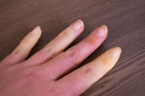 Qu'est-ce que le syndrome de Raynaud?