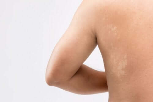 Pityriasis versicolor chez l'adolescent : ce qu'il faut savoir