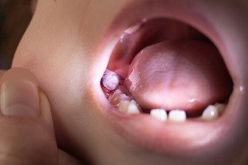 Kyste dentaire chez l'enfant: comment le traiter?