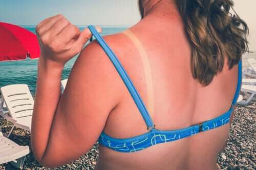 Coups de soleil pendant la grossesse : que faire et comment les traiter