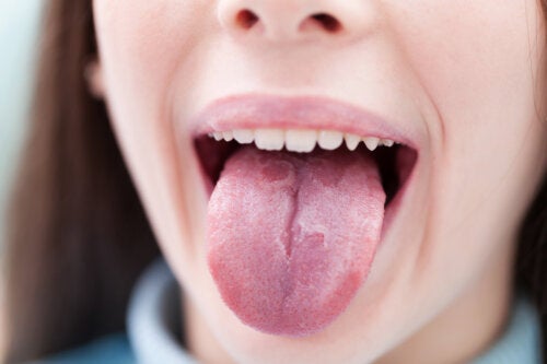 6 maladies infantiles avec des manifestations sur la langue