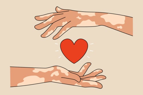 9 conseils pour les parents d'enfants atteints de vitiligo
