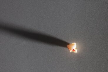 Perte prématurée d'une dent de lait : causes et conséquences