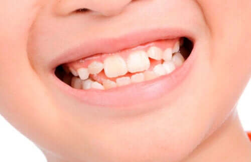 Amélogénèse imparfaite : de quoi s'agit-il?